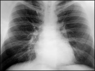 What is mesothelioma